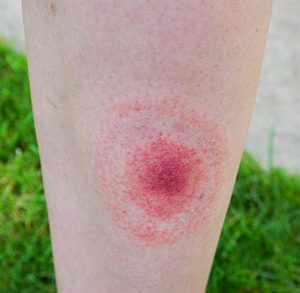 Borreliose: Welche Symptome gibt es? – Linden Apotheke