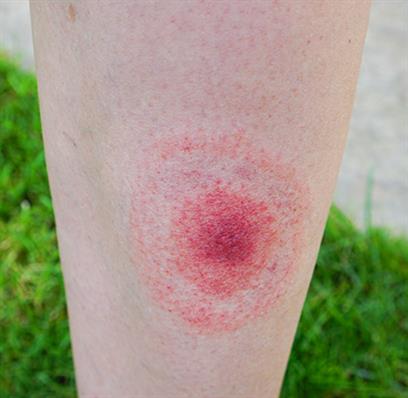 Borreliose: Welche Symptome Gibt Es? – Linden Apotheke