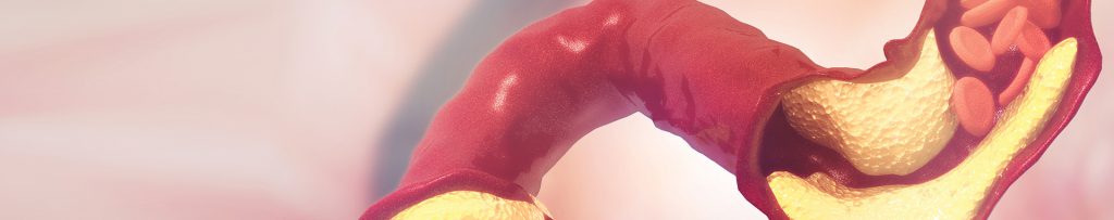 Cholesterin Arterie - Darstellung